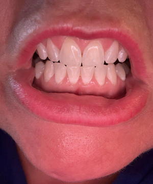 Gradual Results That Feel More Natural